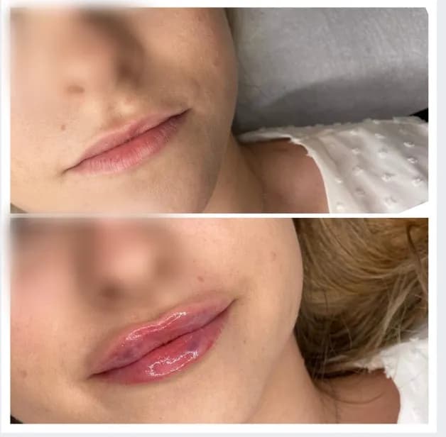 Gdzie najlepiej powiększyć usta w Krakowie? Opinie i ceny klinik