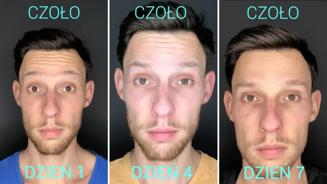 Botoks kiedy efekt - jak szybko zobaczysz rezultaty i co warto wiedzieć