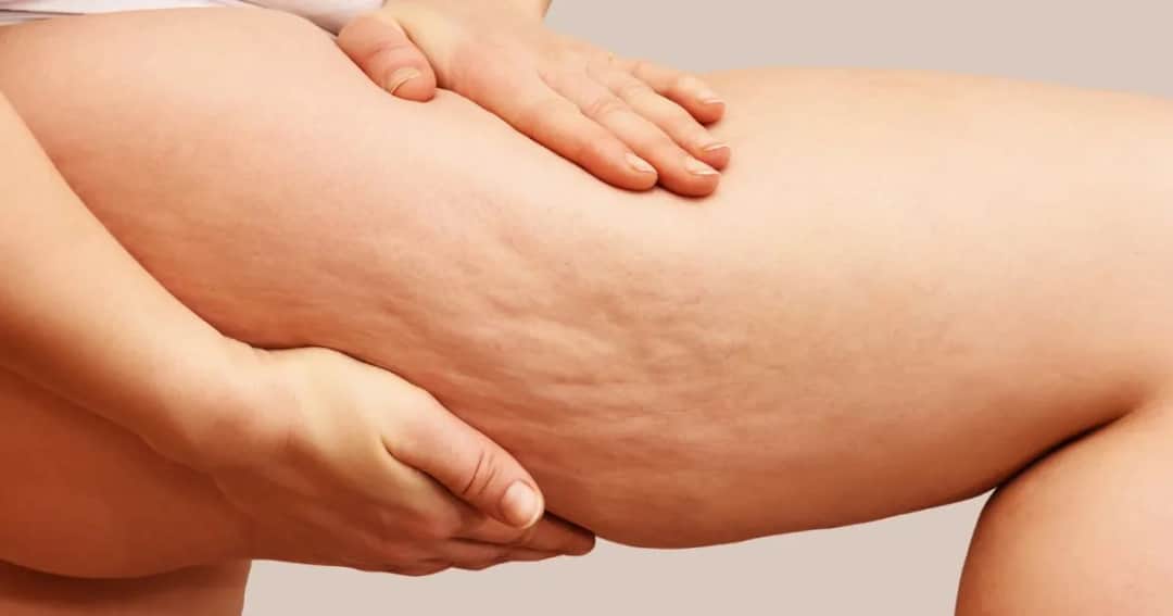 Jakie zioła na cellulit skutecznie poprawią wygląd twojej skóry